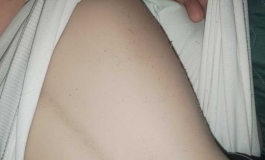 求助！娃娃身上的这些颗粒是怎么形成的！要怎么预防！？