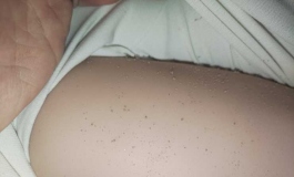 求助！娃娃身上的这些颗粒是怎么形成的！要怎么预防！？
